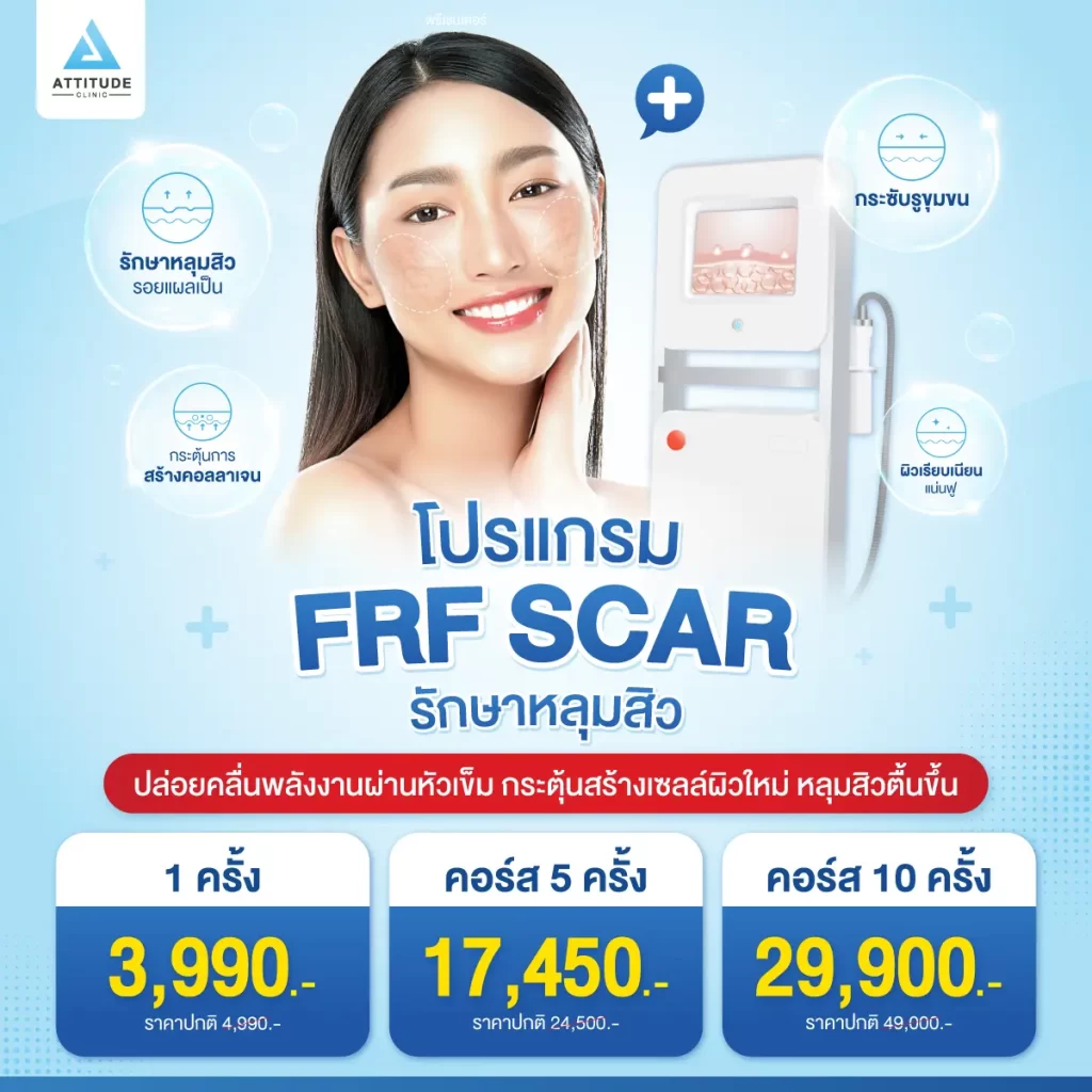 โปรโมชั่นรักษาหลุมสิว โปรแกรม FRF SCAR ปล่อยคลื่นพลังงานผ่านหัวเข็มนาโน กระตุ้นสร้างเซลล์ผิวใหม่ หลุมสิวตื้นขึ้น ฟื้นฟูผิวเรียบเนียนขึ้น!