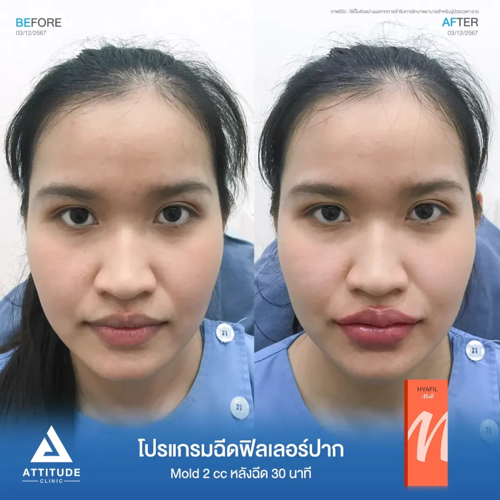 รีวิวโปรแกรมฉีดฟิลเลอร์ปากคุณฟ้า รุ่น M จำนวน 2 cc หลังฉีด 30 นาทีของคุณฟ้า เติมเต็มร่องริมฝีปากให้ปากที่ดูแห้งเหี่ยวกลับมาอวบอิ่ม ปรับทรงปาก มีมิติได้ทรงสวยตามต้องการที่ Attitude Clinic