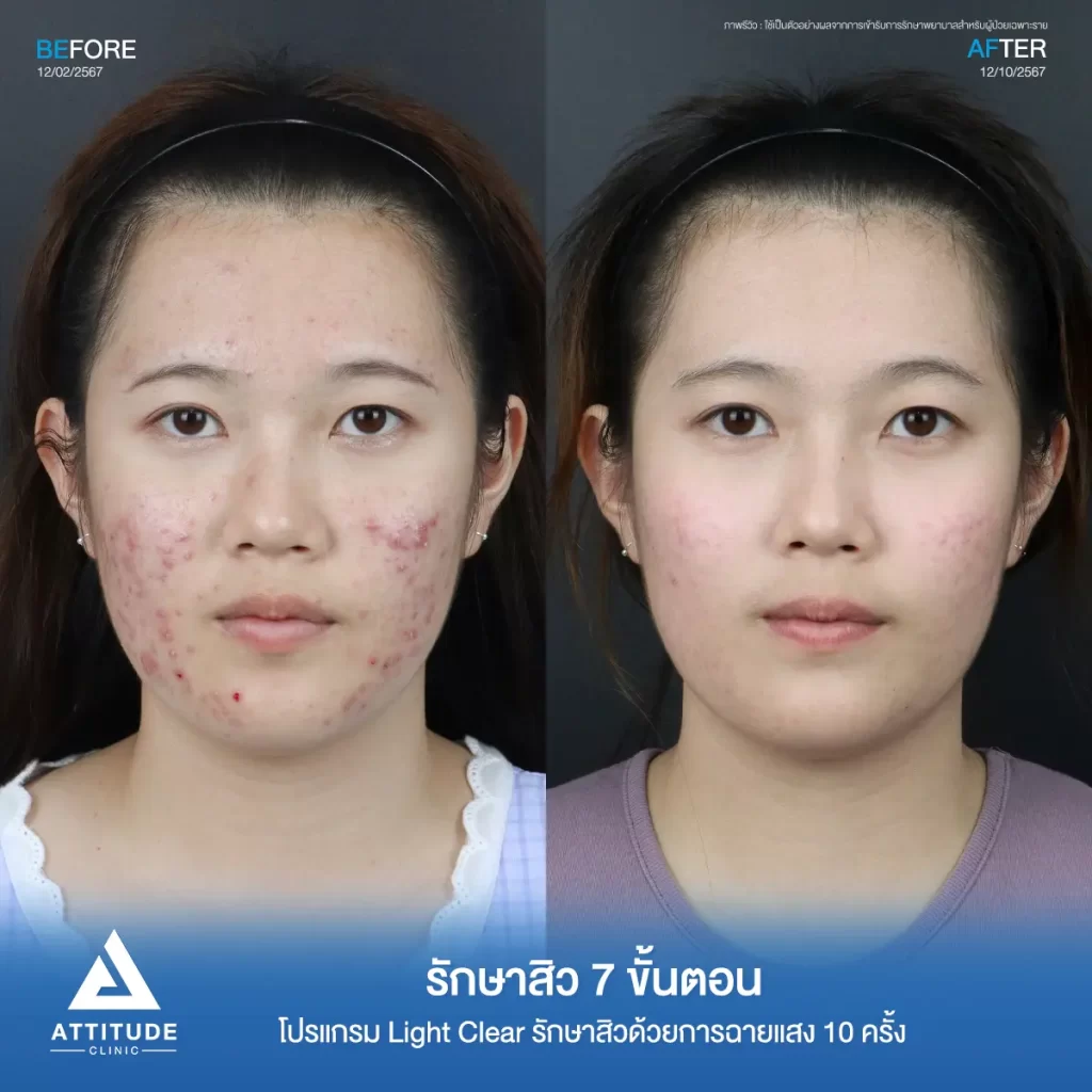 รีวิวรักษาสิวคุณมิ้ว ด้วยการฉายแสง โปรแกรมรักษาสิว Light Clear 7 ขั้นตอน จำนวน 10 ครั้ง รักษาสิวอักเสบหัวหนองเม็ดใหญ่ๆ สิวอุดตัน รอยแดงทั่วใบหน้า โดยเฉพาะบริเวณแก้ม 2 ข้างที่ Attitude Clinic