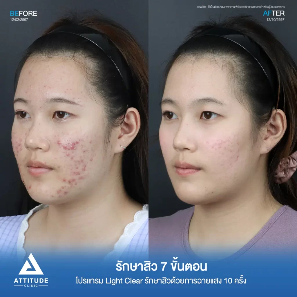รีวิวรักษาสิวคุณมิ้ว ด้วยการฉายแสง โปรแกรมรักษาสิว Light Clear 7 ขั้นตอน จำนวน 10 ครั้ง รักษาสิวอักเสบหัวหนองเม็ดใหญ่ๆ สิวอุดตัน รอยแดงทั่วใบหน้า โดยเฉพาะบริเวณแก้ม 2 ข้างที่ Attitude Clinic