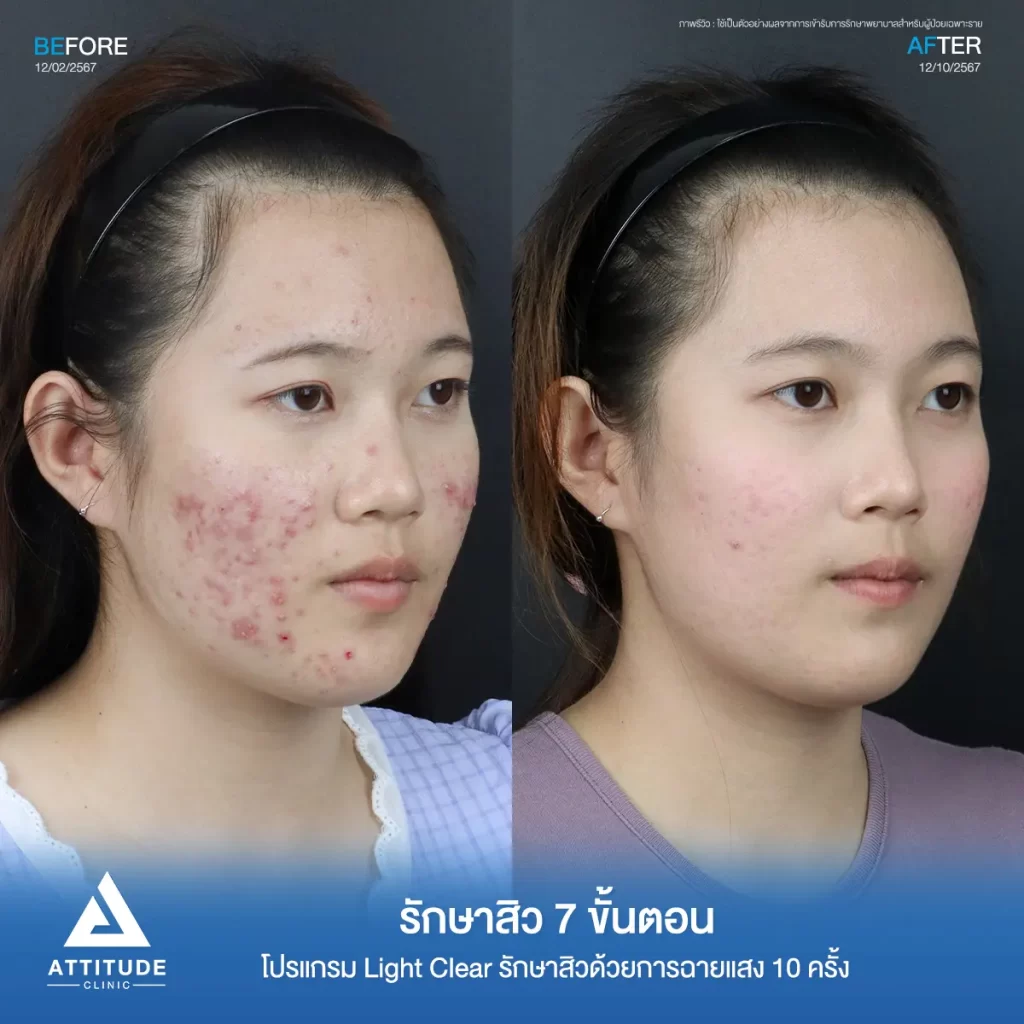 รีวิวรักษาสิวคุณมิ้ว ด้วยการฉายแสง โปรแกรมรักษาสิว Light Clear 7 ขั้นตอน จำนวน 10 ครั้ง รักษาสิวอักเสบหัวหนองเม็ดใหญ่ๆ สิวอุดตัน รอยแดงทั่วใบหน้า โดยเฉพาะบริเวณแก้ม 2 ข้างที่ Attitude Clinic
