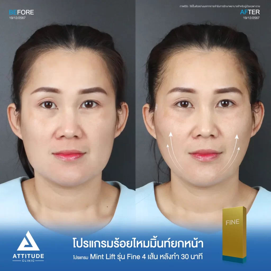 รีวิวโปรแกรมร้อยไหมมิ้นท์ รุ่น Fine จำนวน 4 เส้น ของคุณแนน หลังทำ 30 นาที ยกกระชับข้างแก้ม เก็บกรอบหน้าให้เรียวได้รูปมากขึ้น ดูแล และวิเคราะห์ใบหน้าโดยคุณหมอที่ Attitude Clinic