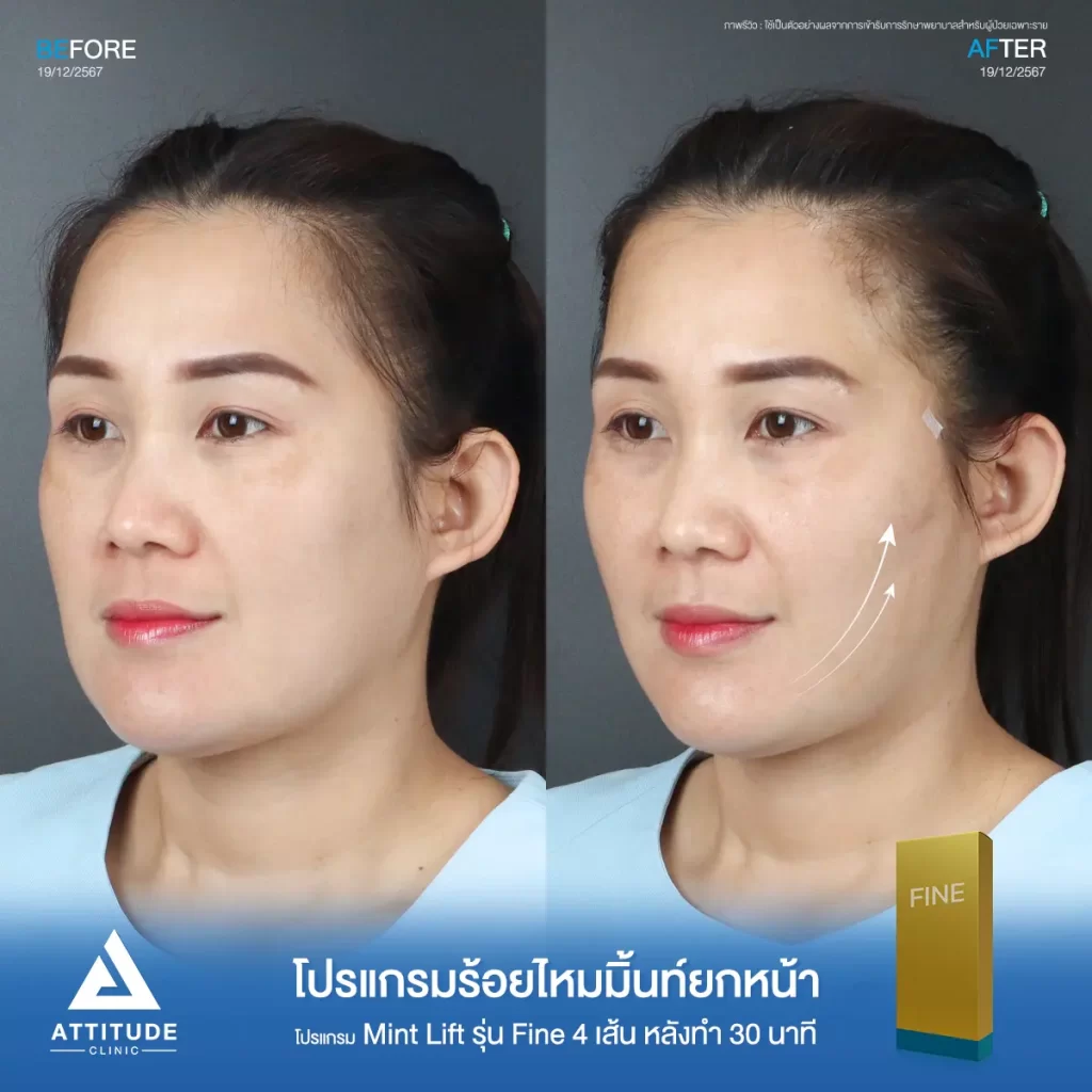 รีวิวโปรแกรมร้อยไหมมิ้นท์ รุ่น Fine จำนวน 4 เส้น ของคุณแนน หลังทำ 30 นาที ยกกระชับข้างแก้ม เก็บกรอบหน้าให้เรียวได้รูปมากขึ้น ดูแล และวิเคราะห์ใบหน้าโดยคุณหมอที่ Attitude Clinic