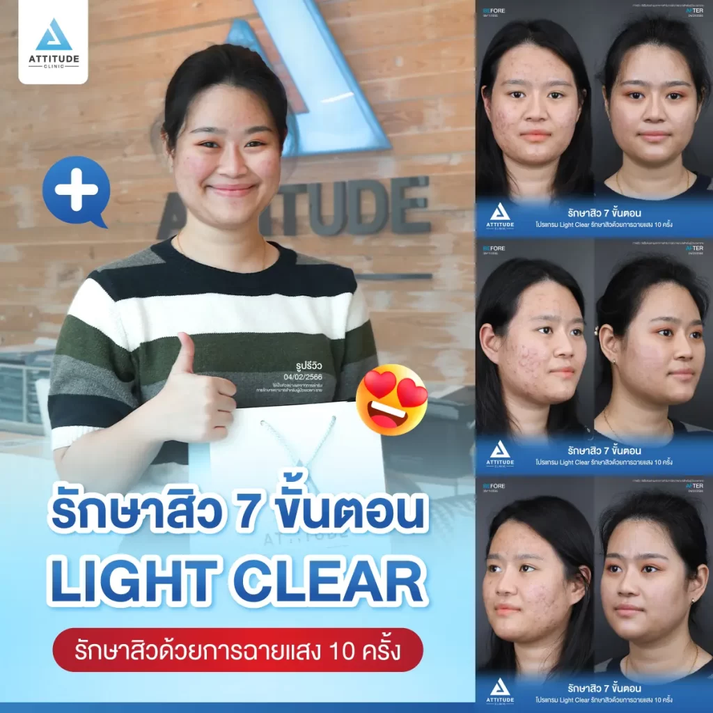 รีวิวรักษาสิวคุณธนาภา ด้วยการฉายแสง โปรแกรมรักษาสิว Light Clear 7 ขั้นตอน จำนวน 10 ครั้ง รักษาสิวอักเสบหัวหนอง สิวอุดตัน สิวผดเม็ดเล็กๆ รอยแดงทั่วใบหน้าที่ Attitude Clinic