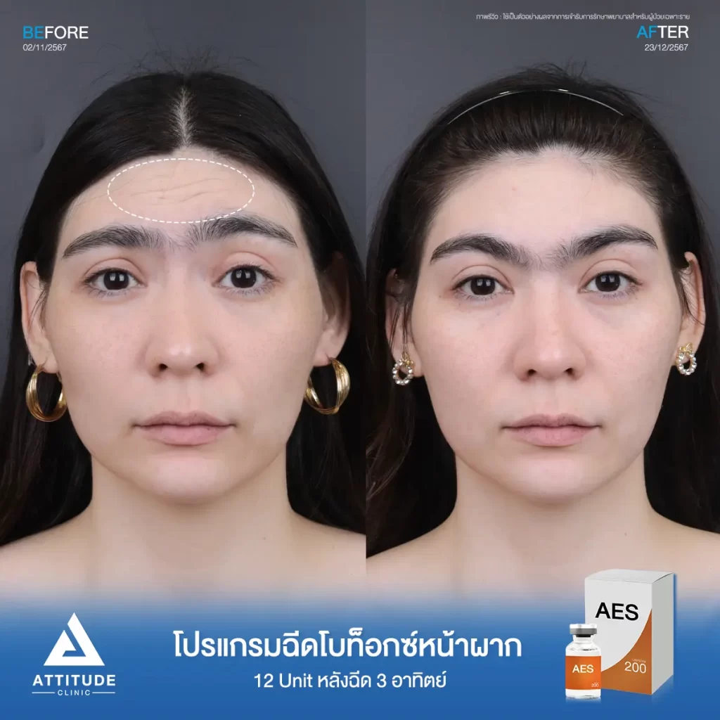 รีวิวโปรแกรมฉีดโบท็อกซ์ลดเลือนริ้วรอยคุณพิมพ์พิสุทธ์ จำนวน 50 Unit บริเวณหน้าผาก หางตา ใต้ตา ระหว่างคิ้วกับคุณหมอที่ Attitude Clinic