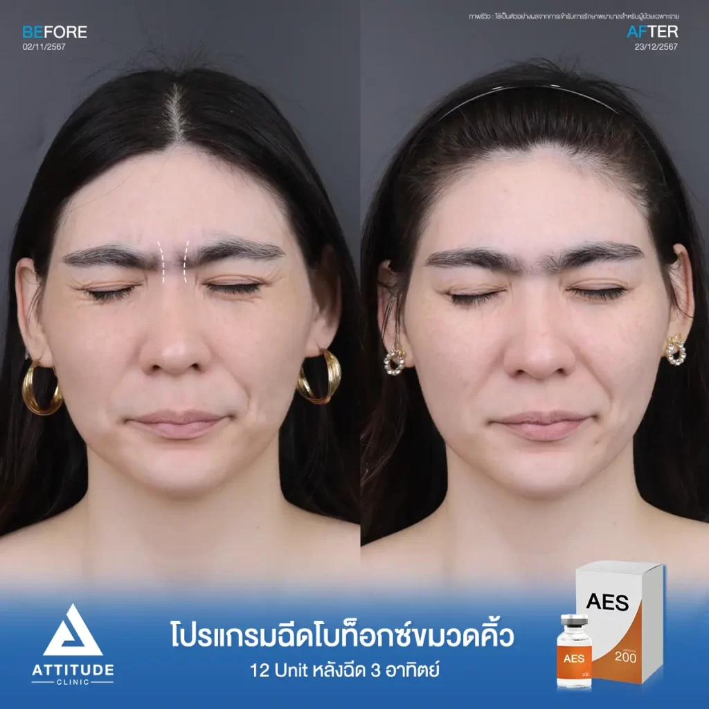รีวิวโปรแกรมฉีดโบท็อกซ์ลดเลือนริ้วรอยคุณพิมพ์พิสุทธ์ จำนวน 50 Unit บริเวณหน้าผาก หางตา ใต้ตา ระหว่างคิ้วกับคุณหมอที่ Attitude Clinic