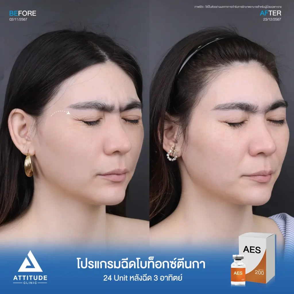 รีวิวโปรแกรมฉีดโบท็อกซ์ลดเลือนริ้วรอยคุณพิมพ์พิสุทธ์ จำนวน 50 Unit บริเวณหน้าผาก หางตา ใต้ตา ระหว่างคิ้วกับคุณหมอที่ Attitude Clinic