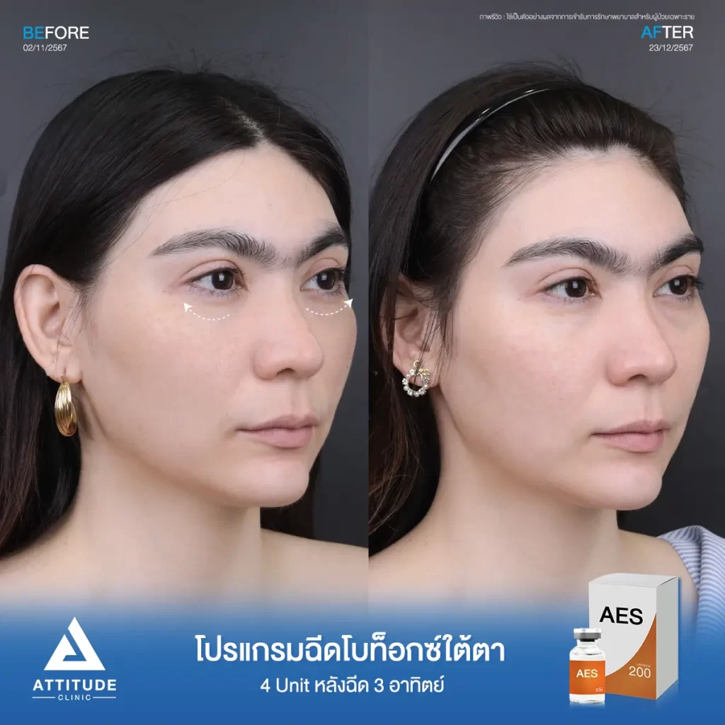 ก่อนฉีด คุณหมอวิเคราะห์ปัญหาริ้วรอยใบหน้าบริเวณ Upper Face เพื่อนคำนวณปริมาณที่ใช้ฉีด และบริเวณที่ฉีดให้ตรงกับปัญหาที่คนไข้อยากแก้ไข  คุณหมอแนะนำโปรแกรมฉีดโบท็อกซ์ ฉีดบริเวณที่มีปัญหาในปริมาณที่เหมาะสมเพื่อลดเลือนริ้วรอย แต่ใบหน้าไม่แข็งตึงจนเกินไป