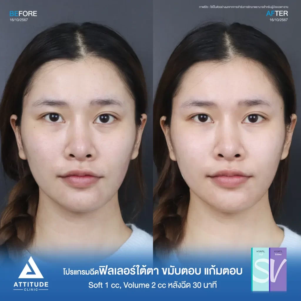 รีวิวโปรแกรมฉีดฟิลเลอร์ใต้ตา ขมับตอบ แก้มตอบ รุ่น Soft 1 cc และรุ่น Volume 2 cc ของน้องนาย หลังฉีด 30 นาที เติมเต็มร่องลึก ปรับรูปหน้าที่ Attitude Clinic