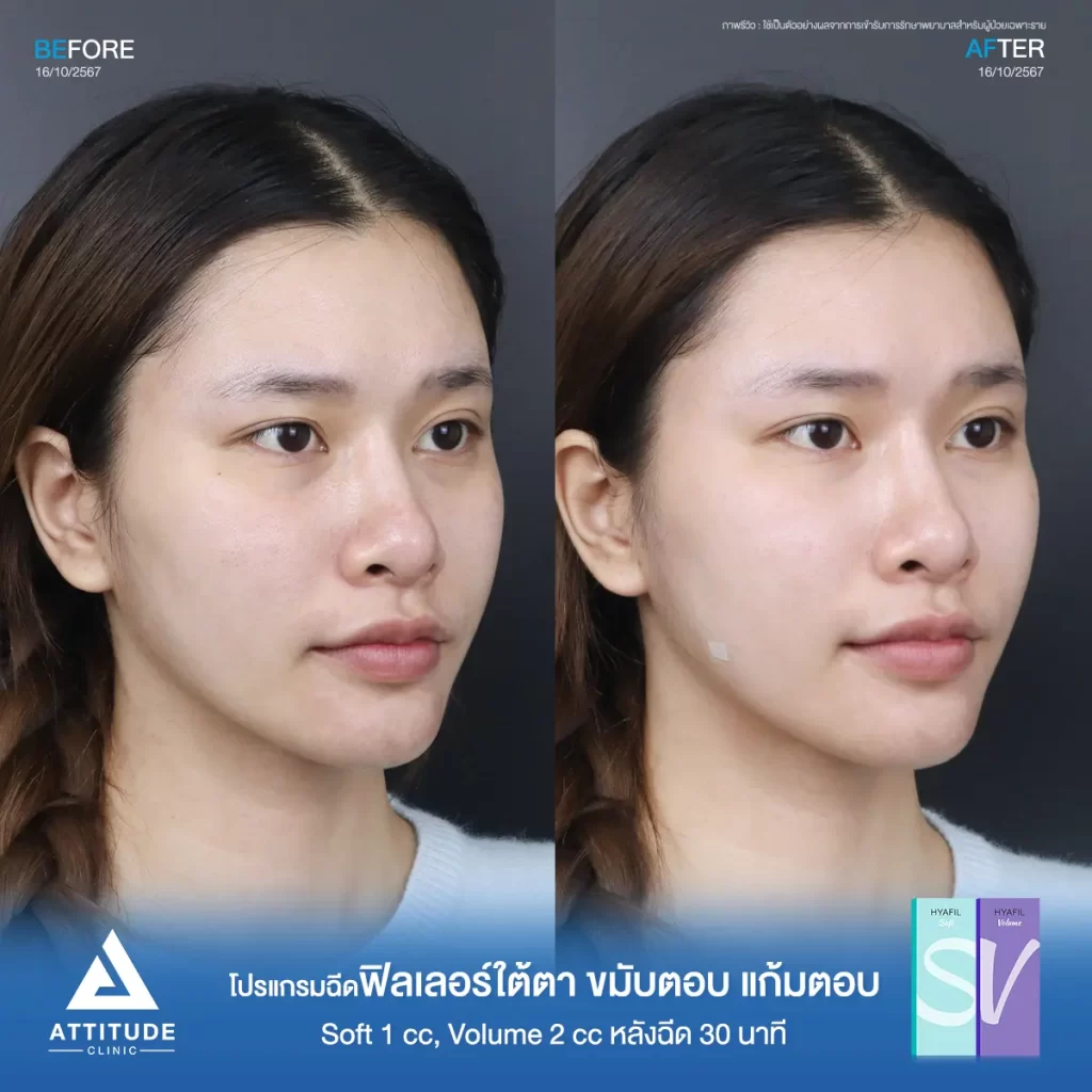 รีวิวโปรแกรมฉีดฟิลเลอร์ใต้ตา ขมับตอบ แก้มตอบ รุ่น Soft 1 cc และรุ่น Volume 2 cc ของน้องนาย หลังฉีด 30 นาที เติมเต็มร่องลึก ปรับรูปหน้าที่ Attitude Clinic