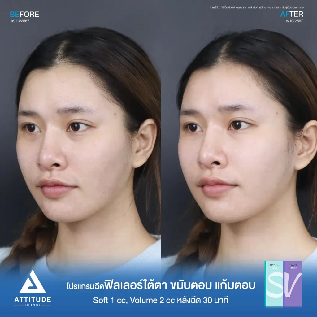 รีวิวโปรแกรมฉีดฟิลเลอร์ใต้ตา ขมับตอบ แก้มตอบ รุ่น Soft 1 cc และรุ่น Volume 2 cc ของน้องนาย หลังฉีด 30 นาที เติมเต็มร่องลึก ปรับรูปหน้าที่ Attitude Clinic