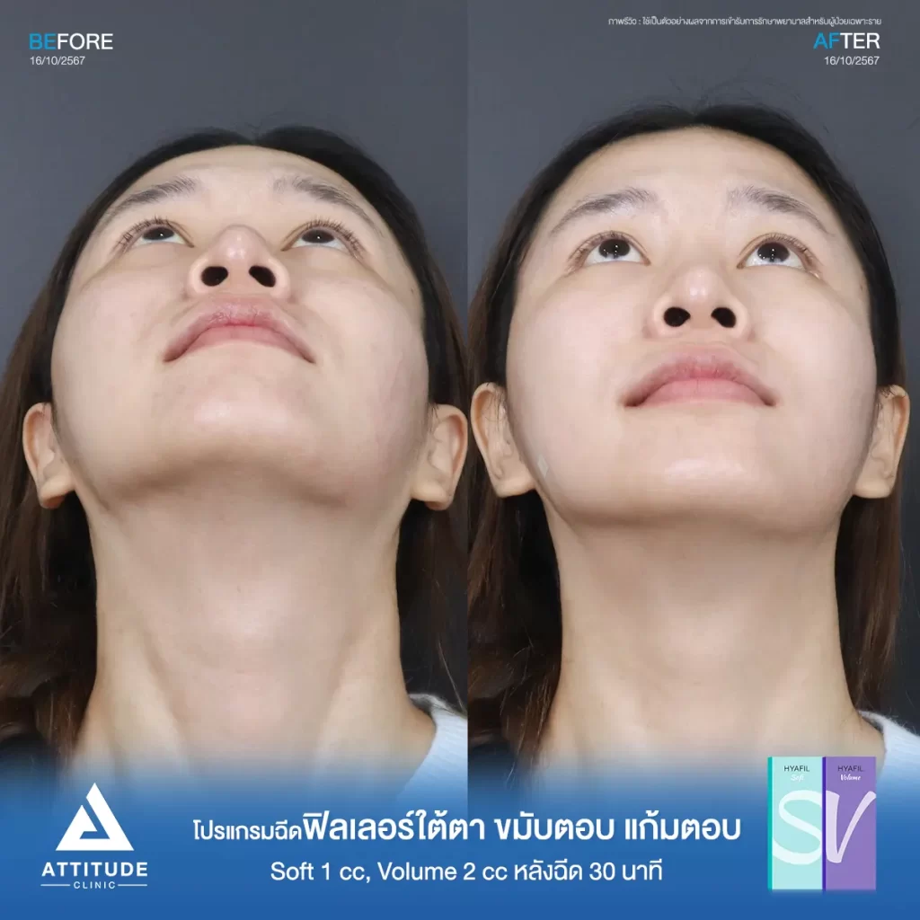 รีวิวโปรแกรมฉีดฟิลเลอร์ใต้ตา ขมับตอบ แก้มตอบ รุ่น Soft 1 cc และรุ่น Volume 2 cc ของน้องนาย หลังฉีด 30 นาที เติมเต็มร่องลึก ปรับรูปหน้าที่ Attitude Clinic