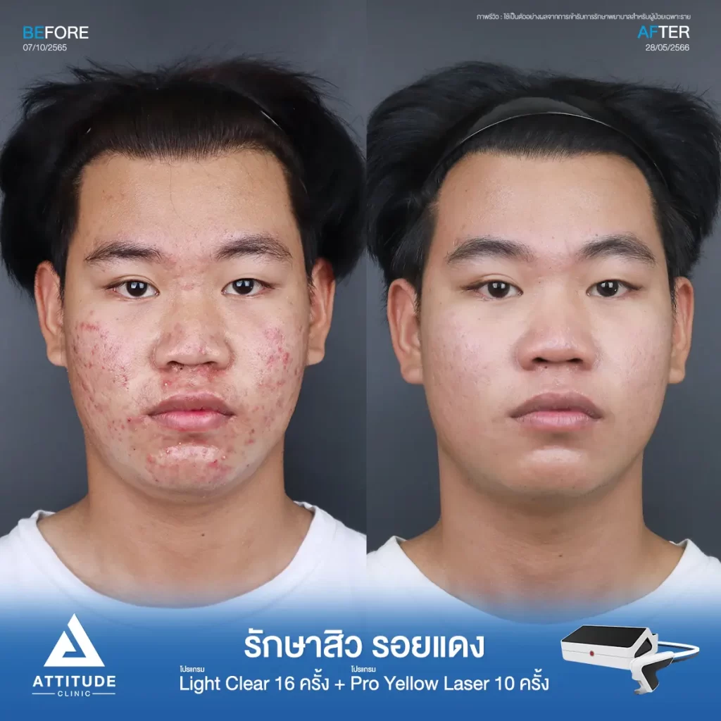 รีวิวรักษาสิวคุณนัทธวัฒน์ ด้วยการฉายแสง โปรแกรมรักษาสิว Light Clear 7 ขั้นตอน จำนวน 16 ครั้ง ต่อด้วยโปรแกรม Pro Yellow Laser รักษารอยแดง จำนวน 10 ครั้ง รักษาสิวอักเสบหัวหนอง สิวอุดตัน สิวผดเม็ดเล็กๆ และรอยแดงทั่วใบหน้าที่ Attitude Clinic