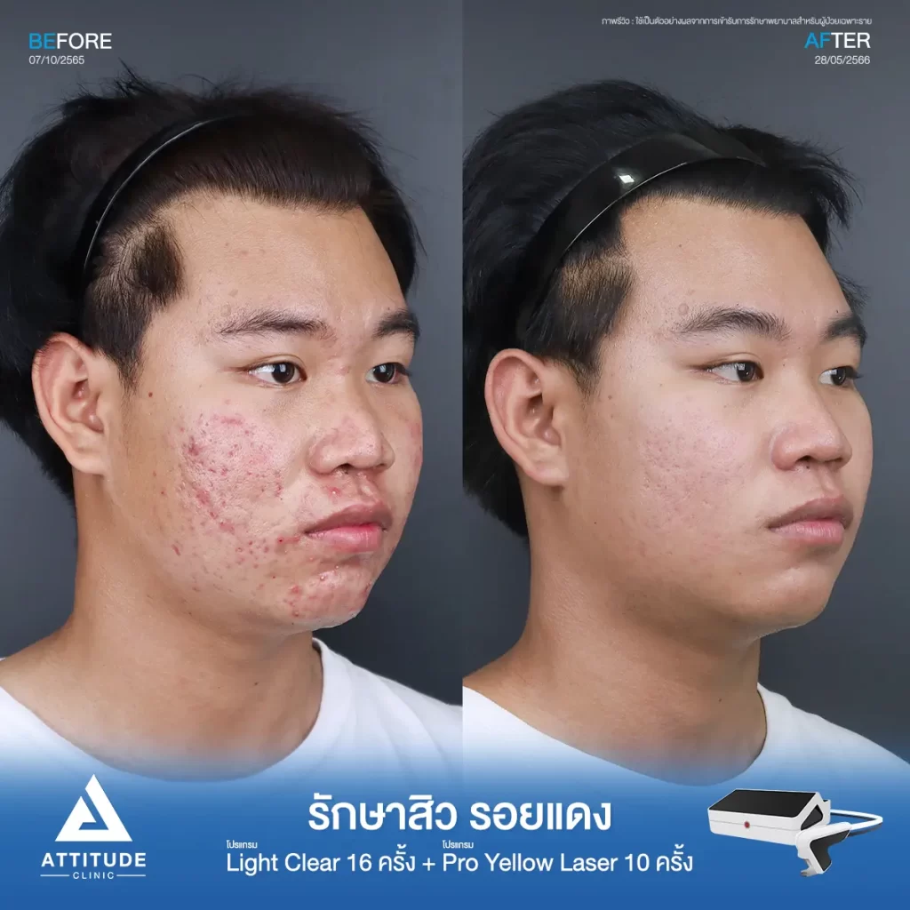 รีวิวรักษาสิวคุณนัทธวัฒน์ ด้วยการฉายแสง โปรแกรมรักษาสิว Light Clear 7 ขั้นตอน จำนวน 16 ครั้ง ต่อด้วยโปรแกรม Pro Yellow Laser รักษารอยแดง จำนวน 10 ครั้ง รักษาสิวอักเสบหัวหนอง สิวอุดตัน สิวผดเม็ดเล็กๆ และรอยแดงทั่วใบหน้าที่ Attitude Clinic