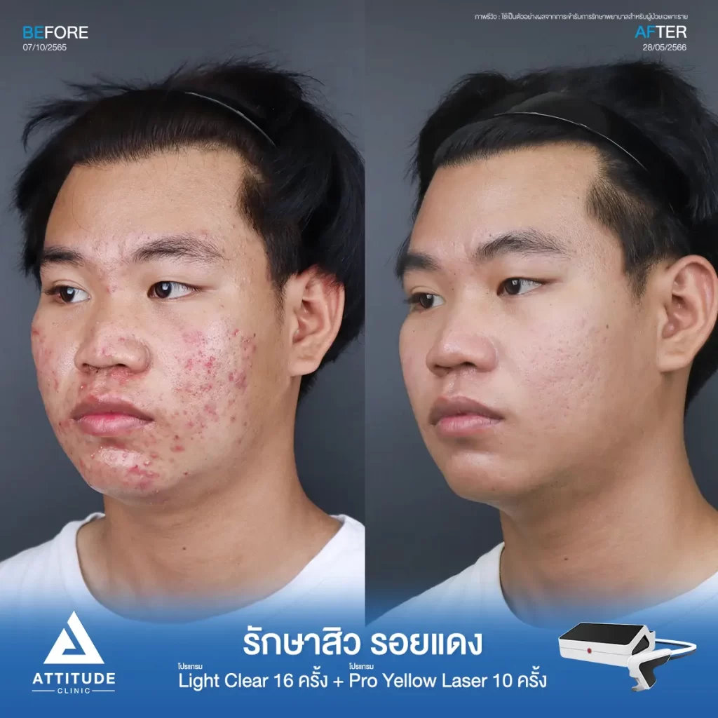 รีวิวรักษาสิวคุณนัทธวัฒน์ ด้วยการฉายแสง โปรแกรมรักษาสิว Light Clear 7 ขั้นตอน จำนวน 16 ครั้ง ต่อด้วยโปรแกรม Pro Yellow Laser รักษารอยแดง จำนวน 10 ครั้ง รักษาสิวอักเสบหัวหนอง สิวอุดตัน สิวผดเม็ดเล็กๆ และรอยแดงทั่วใบหน้าที่ Attitude Clinic