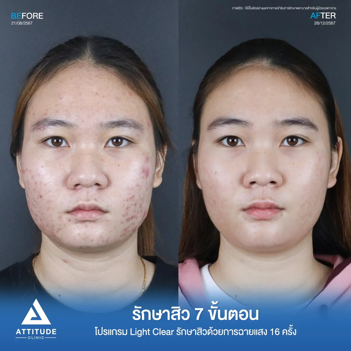 รีวิวรักษาสิวคุณแก้มด้วยการฉายแสง โปรแกรมรักษาสิว Light Clear 7 ขั้นตอน จำนวน 16 ครั้ง รักษาฮอร์โมน สิวอักเสบ สิวอุดตัน รอยแดงทั่วใบหน้าที่ Attitude Clinic