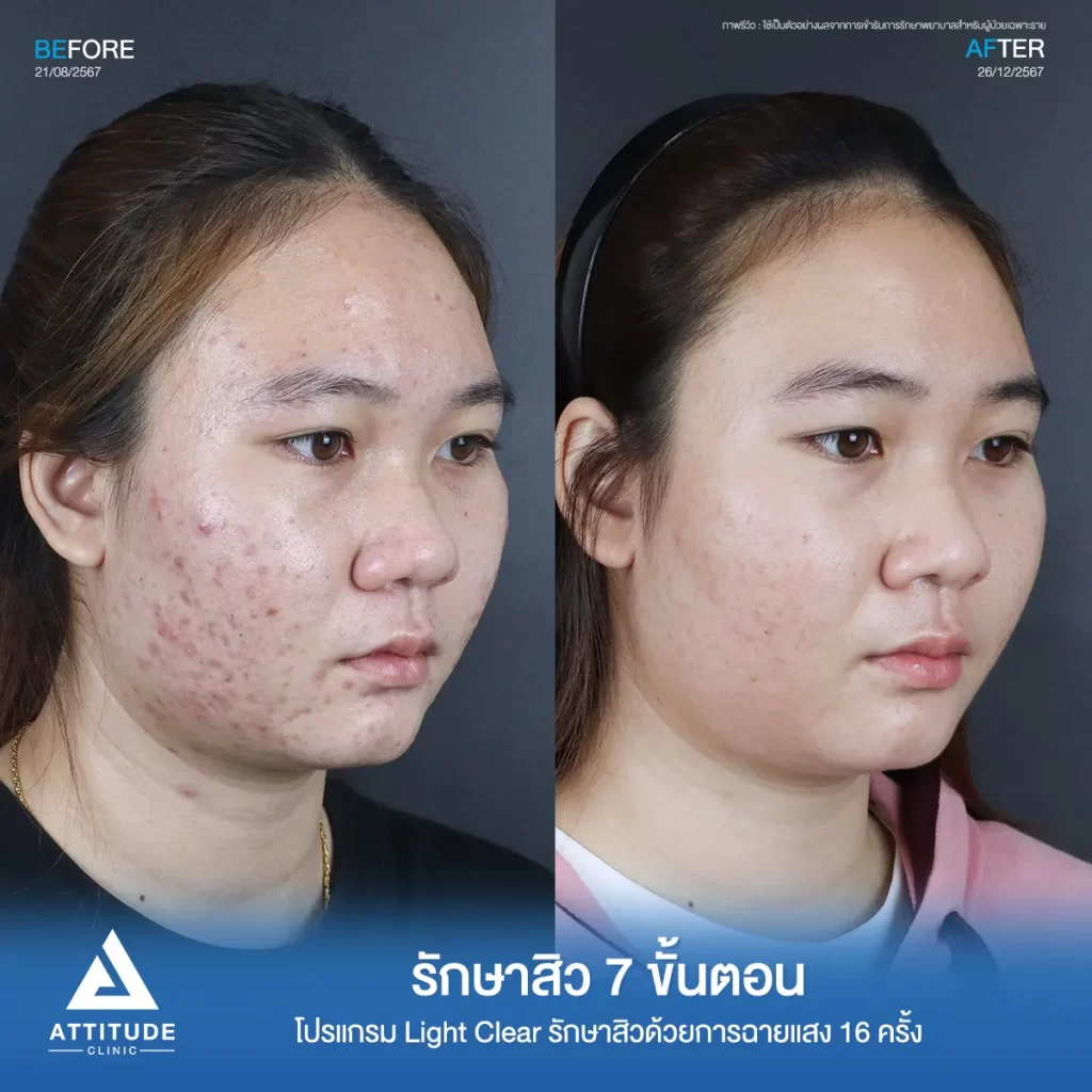 รีวิวรักษาสิวคุณแก้มด้วยการฉายแสง โปรแกรมรักษาสิว Light Clear 7 ขั้นตอน จำนวน 16 ครั้ง รักษาฮอร์โมน สิวอักเสบ สิวอุดตัน รอยแดงทั่วใบหน้าที่ Attitude Clinic
