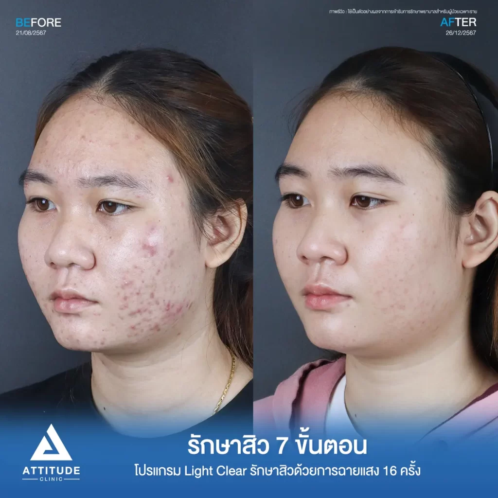 รีวิวรักษาสิวคุณแก้มด้วยการฉายแสง โปรแกรมรักษาสิว Light Clear 7 ขั้นตอน จำนวน 16 ครั้ง รักษาฮอร์โมน สิวอักเสบ สิวอุดตัน รอยแดงทั่วใบหน้าที่ Attitude Clinic