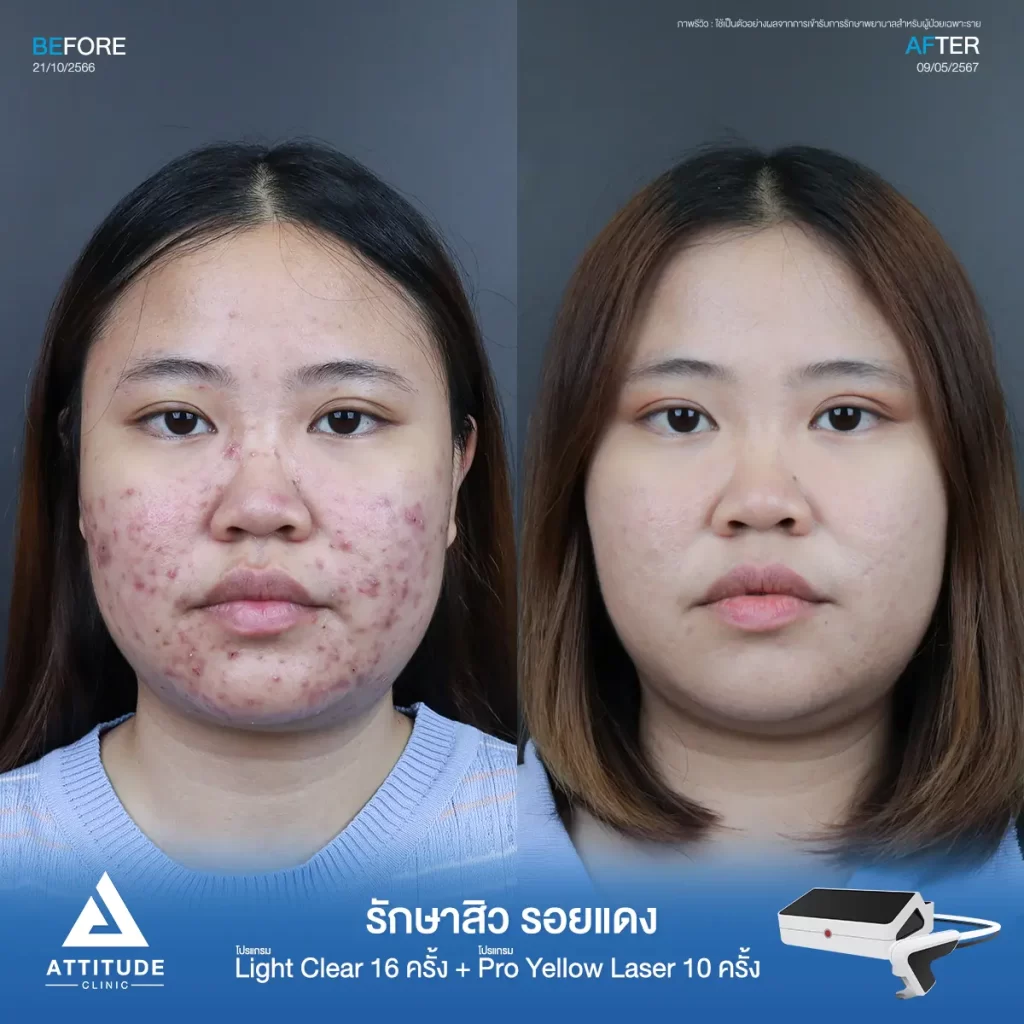 รีวิวรักษาสิวน้องฟาง ด้วยการฉายแสง โปรแกรมรักษาสิว Light Clear 7 ขั้นตอน จำนวน 16 ครั้ง ต่อด้วยโปรแกรม Pro Yellow Laser รักษารอยแดง จำนวน 10 ครั้ง รักษาสิวอักเสบเม็ดใหญ่ สิวอุดตันเม็ดเล็กๆ และรอยแดงทั่วใบหน้าที่ Attitude Clinic