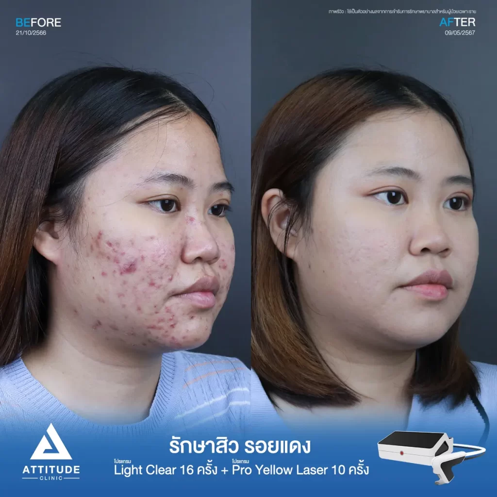รีวิวรักษาสิวน้องฟาง ด้วยการฉายแสง โปรแกรมรักษาสิว Light Clear 7 ขั้นตอน จำนวน 16 ครั้ง ต่อด้วยโปรแกรม Pro Yellow Laser รักษารอยแดง จำนวน 10 ครั้ง รักษาสิวอักเสบเม็ดใหญ่ สิวอุดตันเม็ดเล็กๆ และรอยแดงทั่วใบหน้าที่ Attitude Clinic