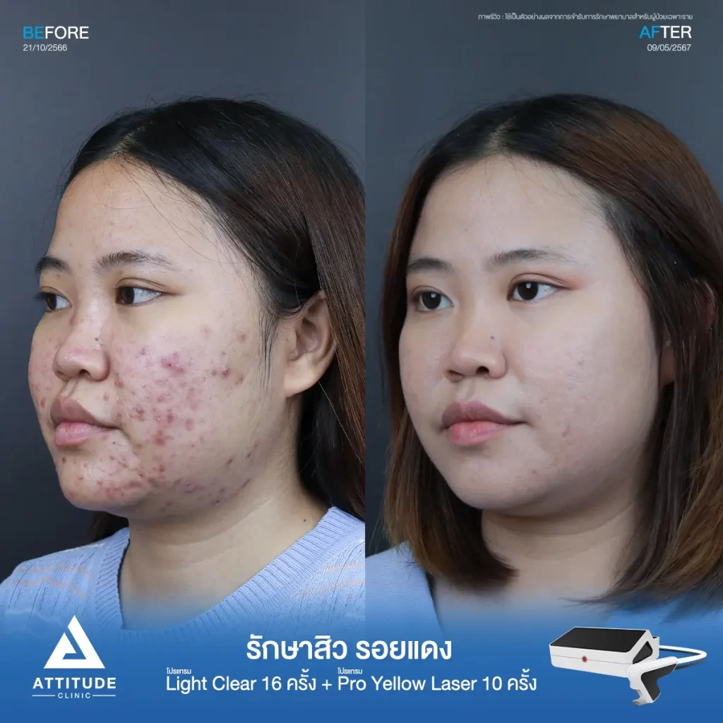 รีวิวรักษาสิวน้องฟาง ด้วยการฉายแสง โปรแกรมรักษาสิว Light Clear 7 ขั้นตอน จำนวน 16 ครั้ง ต่อด้วยโปรแกรม Pro Yellow Laser รักษารอยแดง จำนวน 10 ครั้ง รักษาสิวอักเสบเม็ดใหญ่ สิวอุดตันเม็ดเล็กๆ และรอยแดงทั่วใบหน้าที่ Attitude Clinic