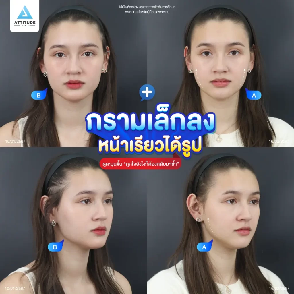 ซัมเมอร์นี้หน้าต้องพร้อม ขอปรับรูปหน้า แก้ปัญหาหน้าใหญ่ด้วยโปรแกรมฉีดโบท็อกซ์ลดขนาดกล้ามเนื้อกราม