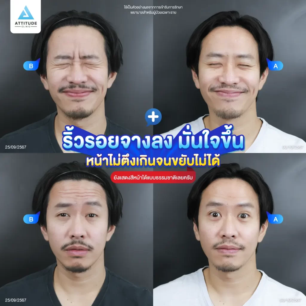 ซัมเมอร์นี้หน้าต้องพร้อม ขอจัดการริ้วรอยกวนใจด้วยโปรแกรมฉีดโบท็อกซ์ลดริ้วรอย