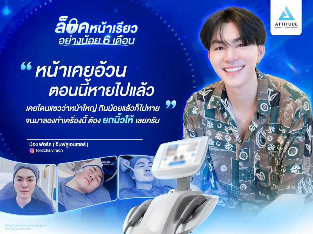 ยืนยันอีก 1 เสียงว่าผู้ชายก็ทำได้ ล็อคหน้าเรียวอย่างน้ย 6 เดือนด้วยโปรแกรมยกกระชับใบหน้า MMFU