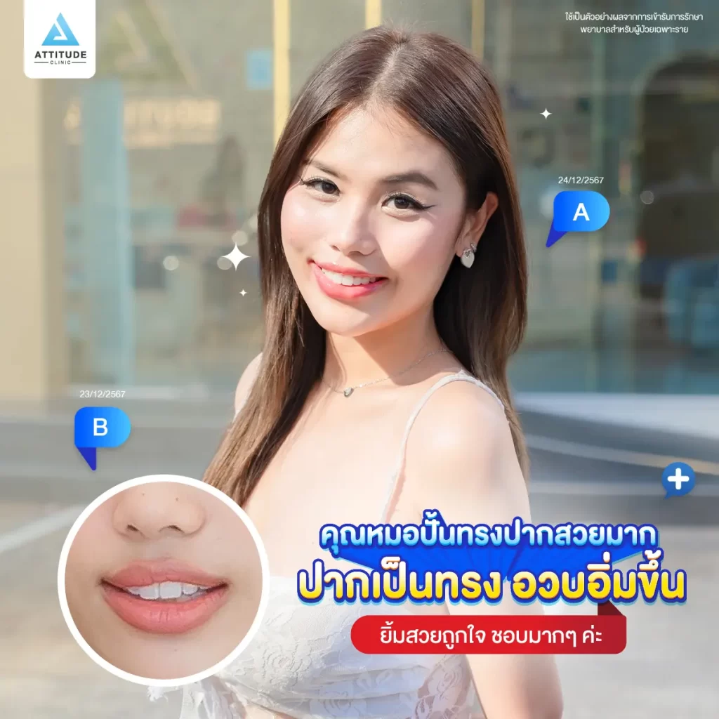 ซัมเมอร์นี้หน้าต้องพร้อม ขอเติมปากสวย น่าจุ๊บด้วยโปรแกรมฉีดฟิลเลอร์ปาก