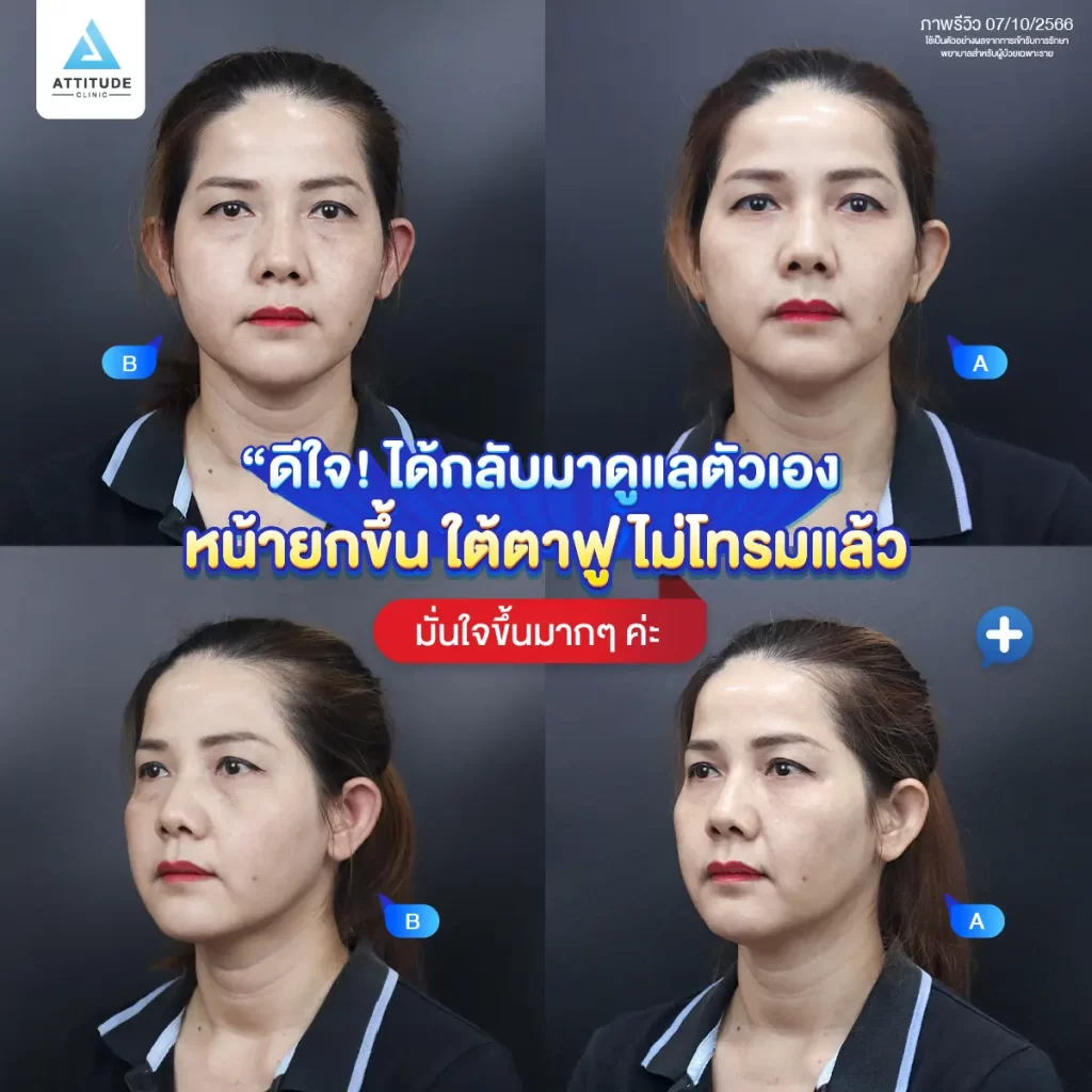ซัมเมอร์นี้หน้าต้องพร้อม พี่แมวแก้ปัญหาใต้ตาด้วยโปรแกรมฉีดฟิลเลอร์ใต้ตา