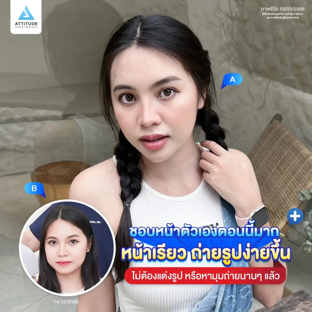 ซัมเมอร์นี้หน้าต้องพร้อม ขอเติมคาง ปรับรูปหน้าให้เรียวสวยด้วยโปรแกรมฉีดฟิลเลอร์คาง