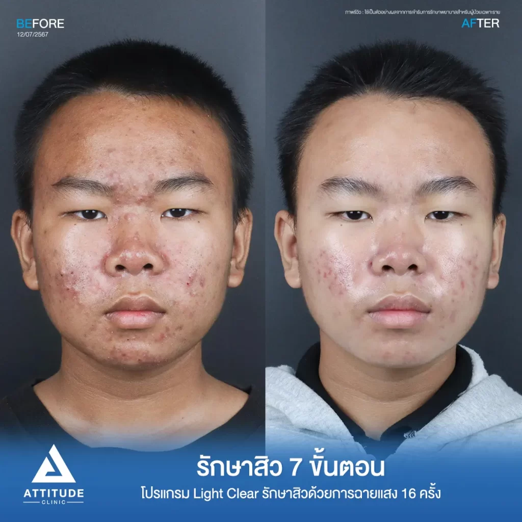 รีวิวรักษาสิวน้องกรด้วยการฉายแสง โปรแกรมรักษาสิว Light Clear 7 ขั้นตอน จำนวน 16 ครั้ง รักษาสิวฮอร์โมน สิวอักเสบหัวหนองเม็ดใหญ่ สิวอุดตันเม็ดเล็กๆ และรอยแดงทั่วใบหน้าที่ Attitude Clinic