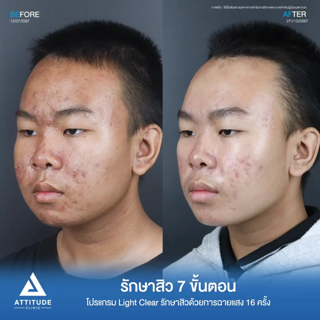 รีวิวรักษาสิวน้องกรด้วยการฉายแสง โปรแกรมรักษาสิว Light Clear 7 ขั้นตอน จำนวน 16 ครั้ง รักษาสิวฮอร์โมน สิวอักเสบหัวหนองเม็ดใหญ่ สิวอุดตันเม็ดเล็กๆ และรอยแดงทั่วใบหน้าที่ Attitude Clinic