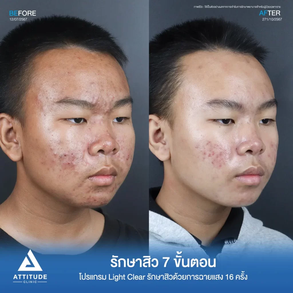 รีวิวรักษาสิวน้องกรด้วยการฉายแสง โปรแกรมรักษาสิว Light Clear 7 ขั้นตอน จำนวน 16 ครั้ง รักษาสิวฮอร์โมน สิวอักเสบหัวหนองเม็ดใหญ่ สิวอุดตันเม็ดเล็กๆ และรอยแดงทั่วใบหน้าที่ Attitude Clinic
