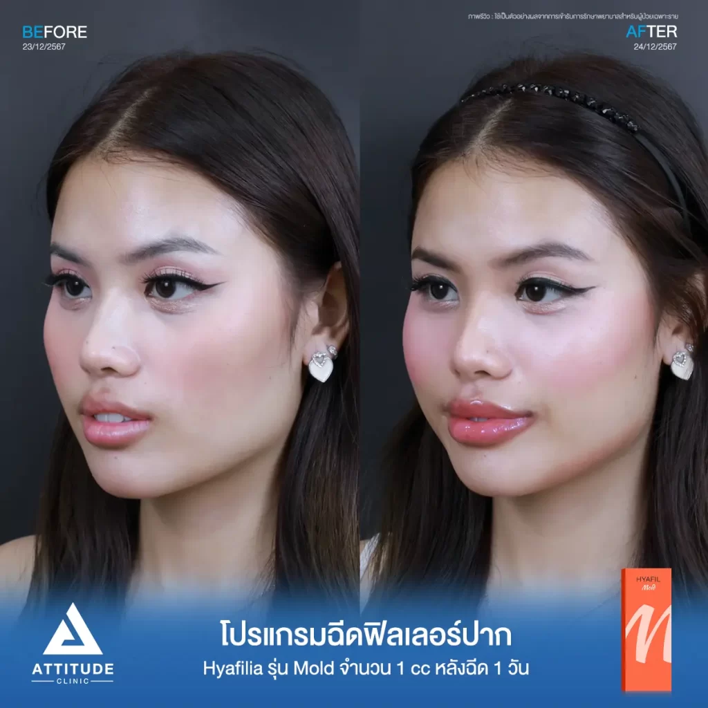รีวิวโปรแกรมฉีดฟิลเลอร์ปากคุณนิกกี้ Hyafilia รุ่น Mold จำนวน 1 cc หลังฉีด 1 วัน ปรับทรงปาก แก้ปัญหาปากคว่ำ เติมเต็มริมฝีปากให้อวบอิ่มที่ Attitude Clinic