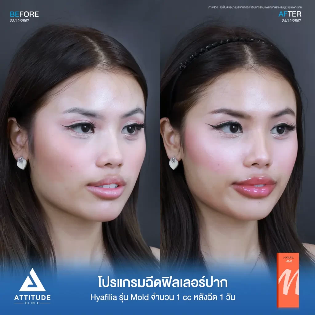รีวิวโปรแกรมฉีดฟิลเลอร์ปากคุณนิกกี้ Hyafilia รุ่น Mold จำนวน 1 cc หลังฉีด 1 วัน ปรับทรงปาก แก้ปัญหาปากคว่ำ เติมเต็มริมฝีปากให้อวบอิ่มที่ Attitude Clinic