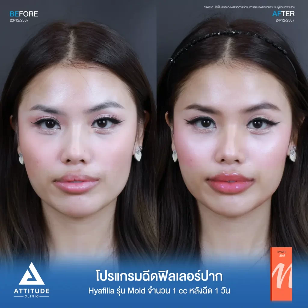 รีวิวโปรแกรมฉีดฟิลเลอร์ปาก Hyafilia รุ่น Mold จำนวน 1 cc หลังฉีด 1 วัน ของคุณนิกกี้ ปรับทรงปาก แก้ปัญหาปากคว่ำ เติมเต็มริมฝีปากให้อวบอิ่มที่ Attitude Clinic