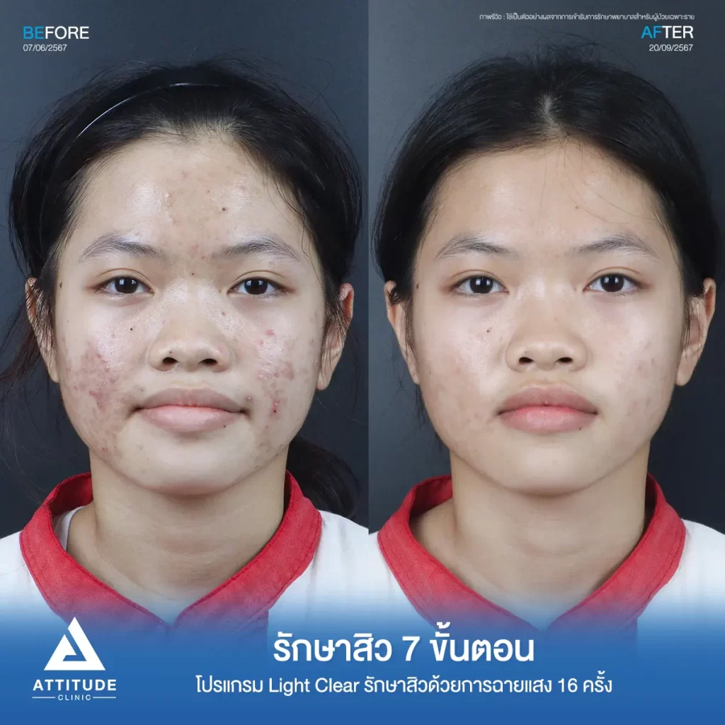 รีวิวรักษาสิวน้องมะปราง โปรแกรม Light Clear จำนวน 16 ครั้ง รักษาสิวสิวอักเสบ สิวอุดตัน และรอยสิวทั่วใบหน้าโดยเฉพาะแก้ม 2 ข้างที่ Attitude Clinic