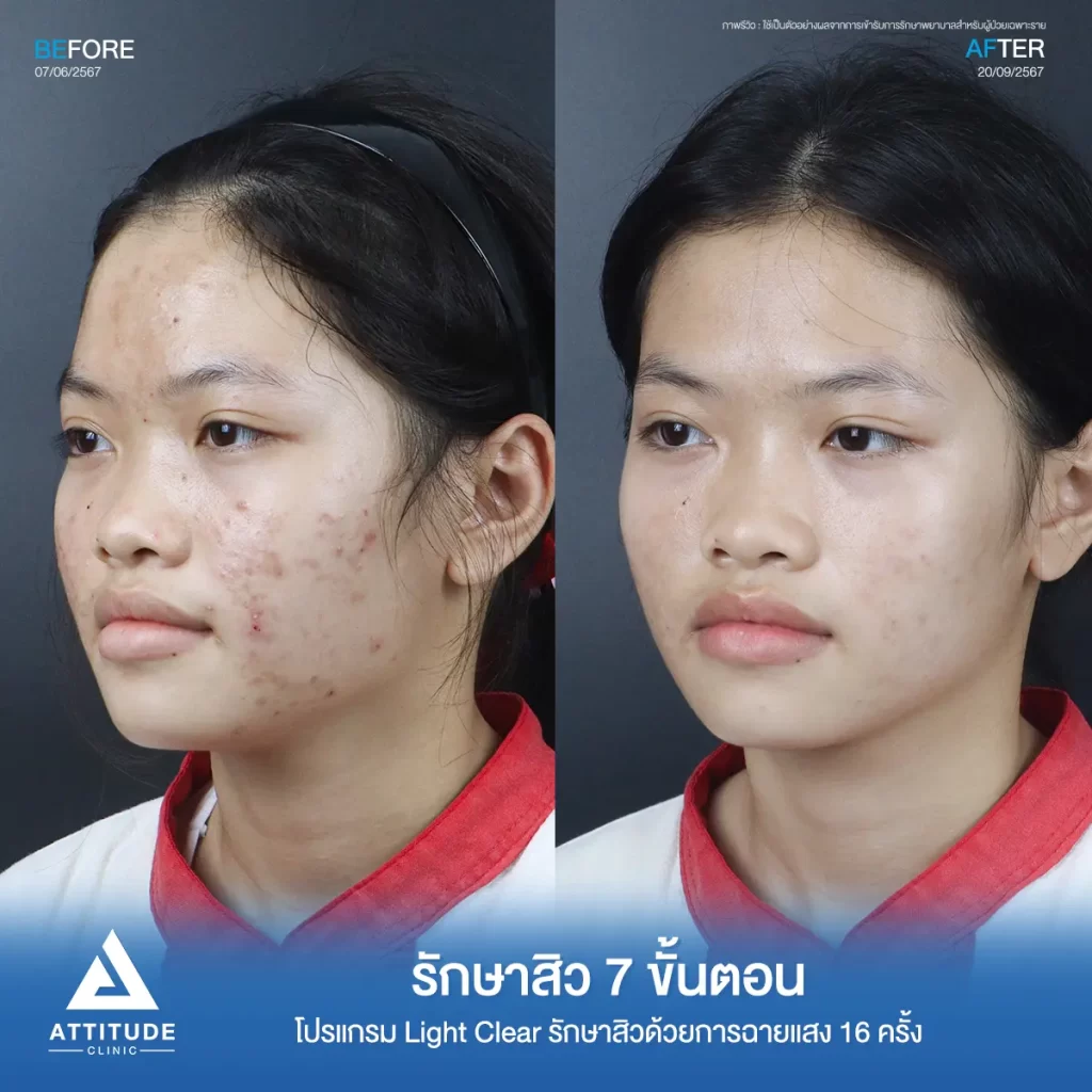 รีวิวรักษาสิวน้องมะปราง โปรแกรม Light Clear จำนวน 16 ครั้ง รักษาสิวสิวอักเสบ สิวอุดตัน และรอยสิวทั่วใบหน้าโดยเฉพาะแก้ม 2 ข้างที่ Attitude Clinic