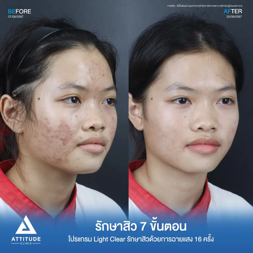 รีวิวรักษาสิวน้องมะปราง โปรแกรม Light Clear จำนวน 16 ครั้ง รักษาสิวสิวอักเสบ สิวอุดตัน และรอยสิวทั่วใบหน้าโดยเฉพาะแก้ม 2 ข้างที่ Attitude Clinic