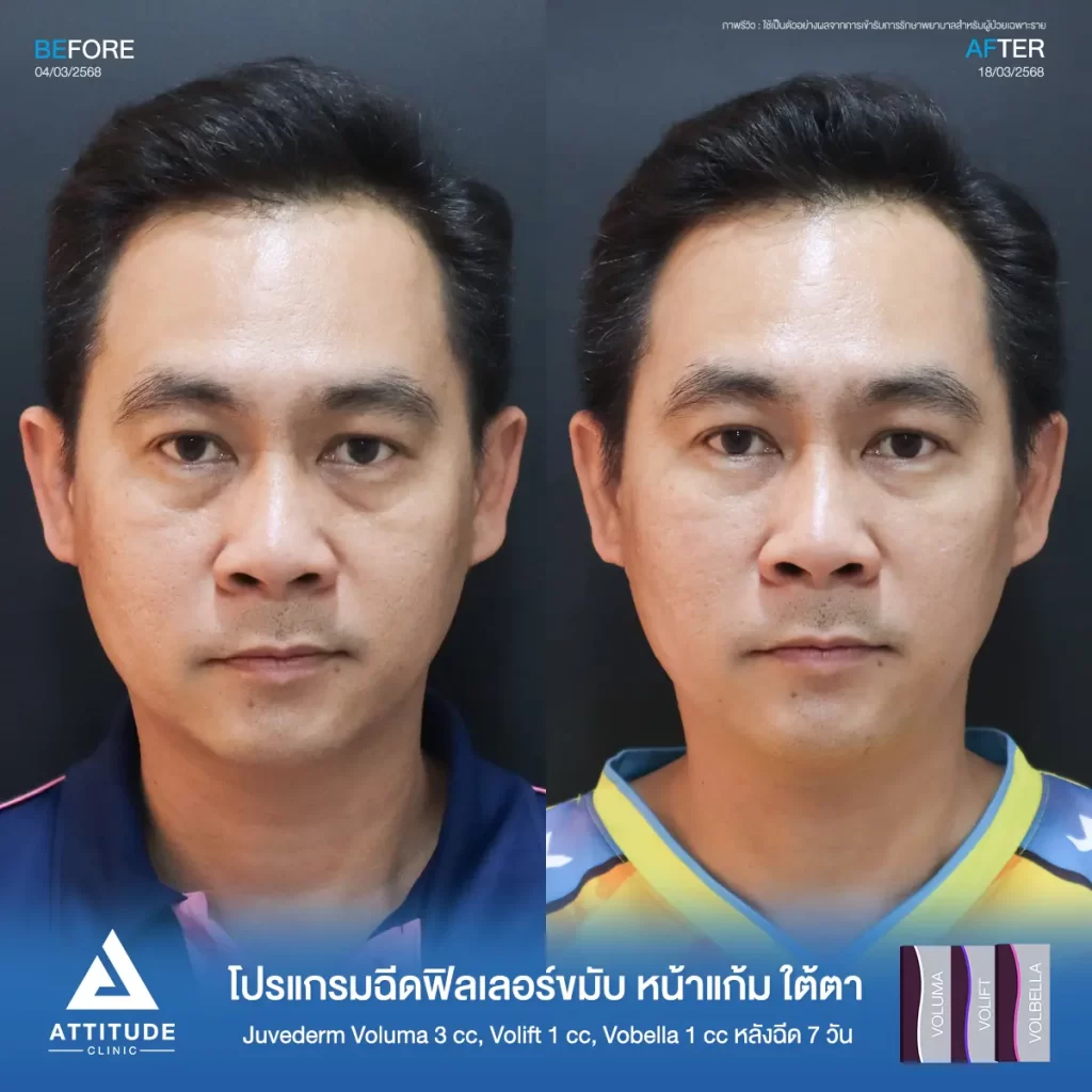 รีวิวโปรแกรมฉีดฟิลเลอร์ขมับ หน้าแก้ม ใต้ตา Juvederm รุ่น Voluma 3 cc ,รุ่น Volift 1 cc และรุ่น Vobella 1 cc รวมฉีดจำนวน 5 cc หลังฉีด 7 วัน ของคุณเอก แก้ปัญหาขมับตอบให้เต็มขึ้น เติมหน้าแก้มให้ดูอิ่ม เติมเต็มร่องลึกใต้ตาให้อิ่มฟู ลดความหมองคล้ำที่ Attitude Clinic