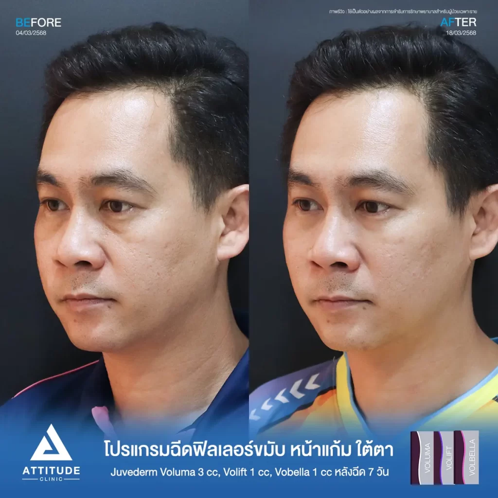 รีวิวโปรแกรมฉีดฟิลเลอร์ขมับ หน้าแก้ม ใต้ตา Juvederm รุ่น Voluma 3 cc ,รุ่น Volift 1 cc และรุ่น Vobella 1 cc รวมฉีดจำนวน 5 cc หลังฉีด 7 วัน ของคุณเอก แก้ปัญหาขมับตอบให้เต็มขึ้น เติมหน้าแก้มให้ดูอิ่ม เติมเต็มร่องลึกใต้ตาให้อิ่มฟู ลดความหมองคล้ำที่ Attitude Clinic