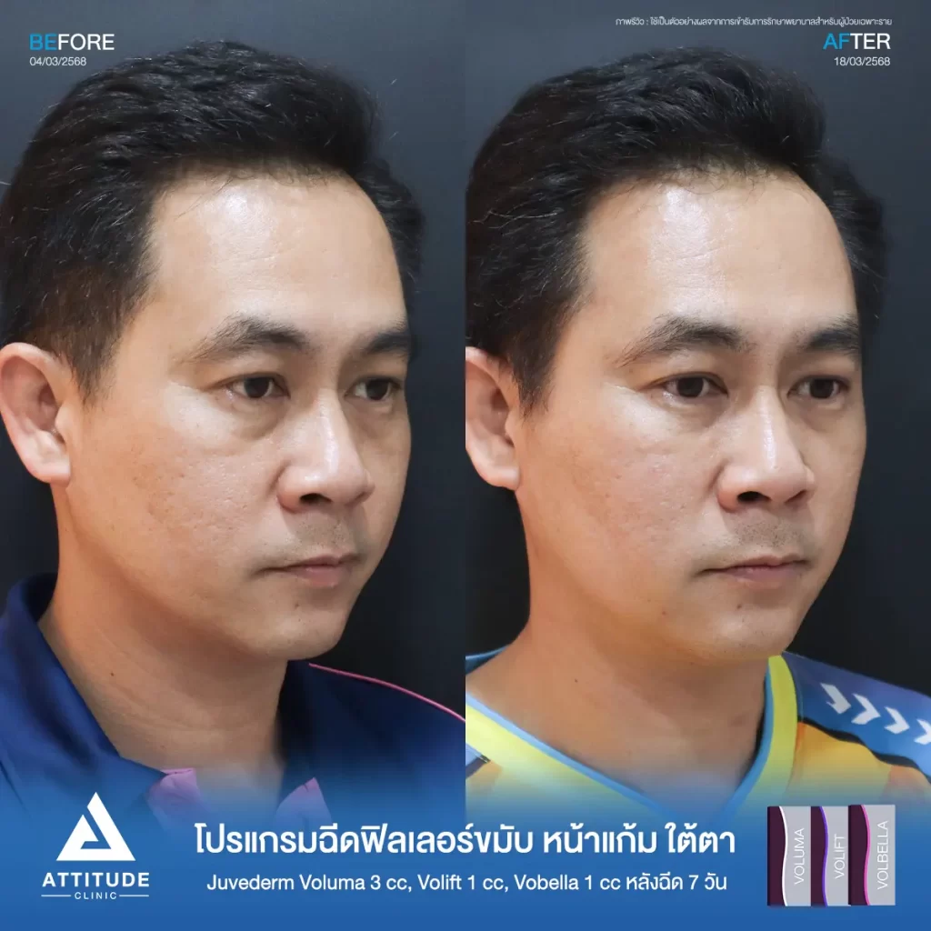 รีวิวโปรแกรมฉีดฟิลเลอร์ขมับ หน้าแก้ม ใต้ตา Juvederm รุ่น Voluma 3 cc ,รุ่น Volift 1 cc และรุ่น Vobella 1 cc รวมฉีดจำนวน 5 cc หลังฉีด 7 วัน ของคุณเอก แก้ปัญหาขมับตอบให้เต็มขึ้น เติมหน้าแก้มให้ดูอิ่ม เติมเต็มร่องลึกใต้ตาให้อิ่มฟู ลดความหมองคล้ำที่ Attitude Clinic