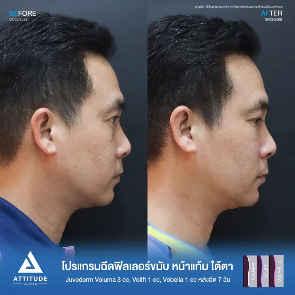 รีวิวโปรแกรมฉีดฟิลเลอร์ขมับ หน้าแก้ม ใต้ตา Juvederm รุ่น Voluma 3 cc ,รุ่น Volift 1 cc และรุ่น Vobella 1 cc รวมฉีดจำนวน 5 cc หลังฉีด 7 วัน ของคุณเอก แก้ปัญหาขมับตอบให้เต็มขึ้น เติมหน้าแก้มให้ดูอิ่ม เติมเต็มร่องลึกใต้ตาให้อิ่มฟู ลดความหมองคล้ำที่ Attitude Clinic