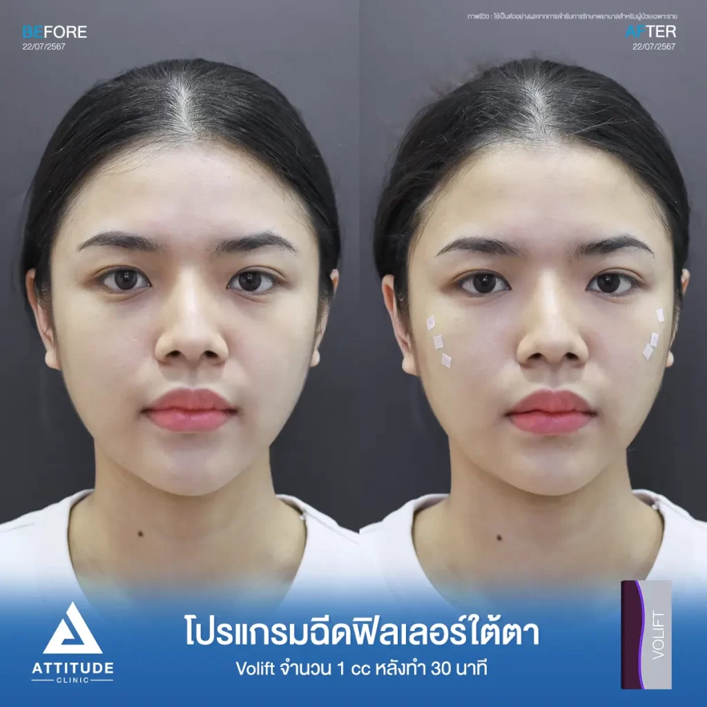 รีวิวโปรแกรมฉีดฟิลเลอร์ใต้ตาพี่พอฤทัย Juvederm รุ่น Volift จำนวน 1 cc ที่ Attitude Clinic