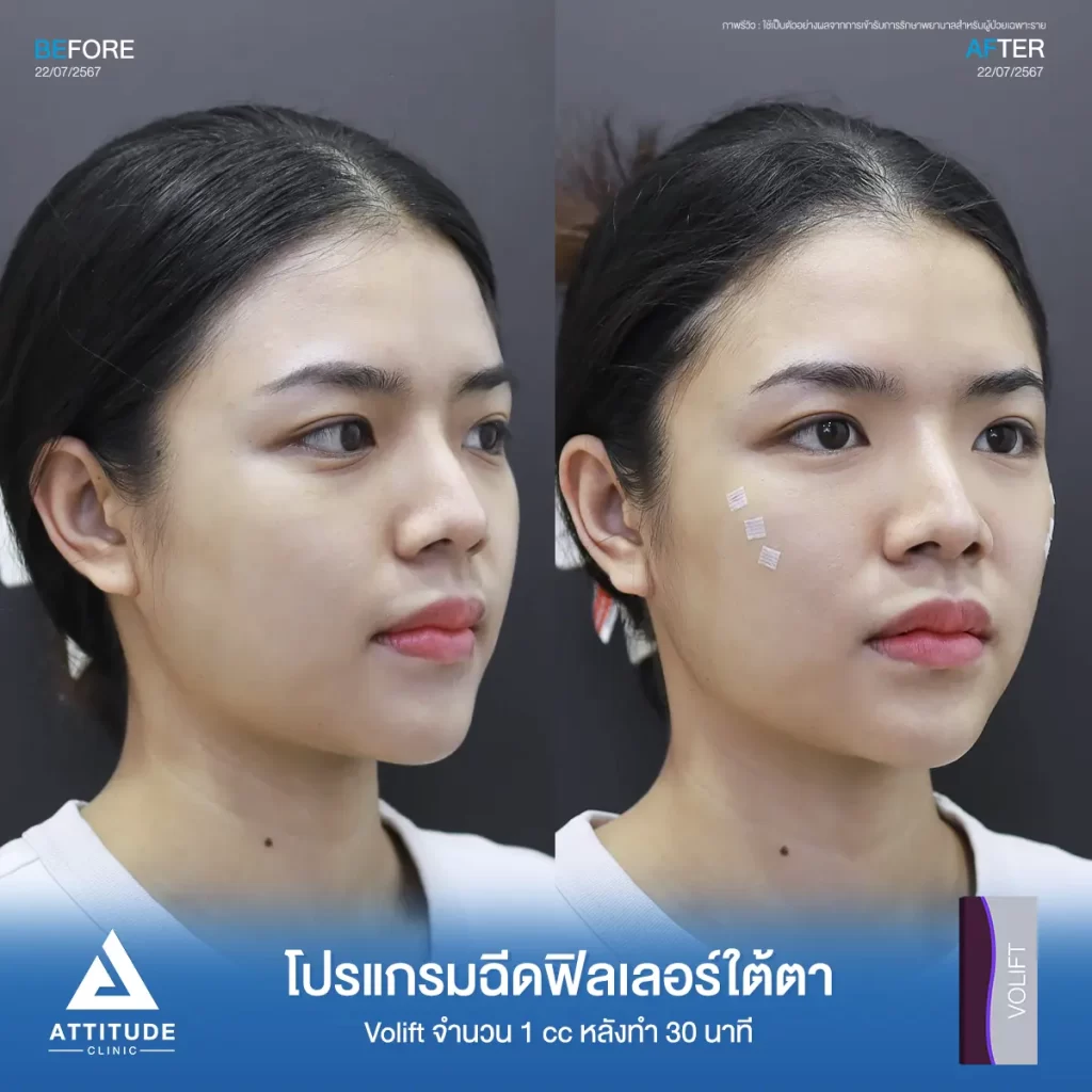 รีวิวโปรแกรมฉีดฟิลเลอร์ใต้ตาพี่พอฤทัย Juvederm รุ่น Volift จำนวน 1 cc ที่ Attitude Clinic