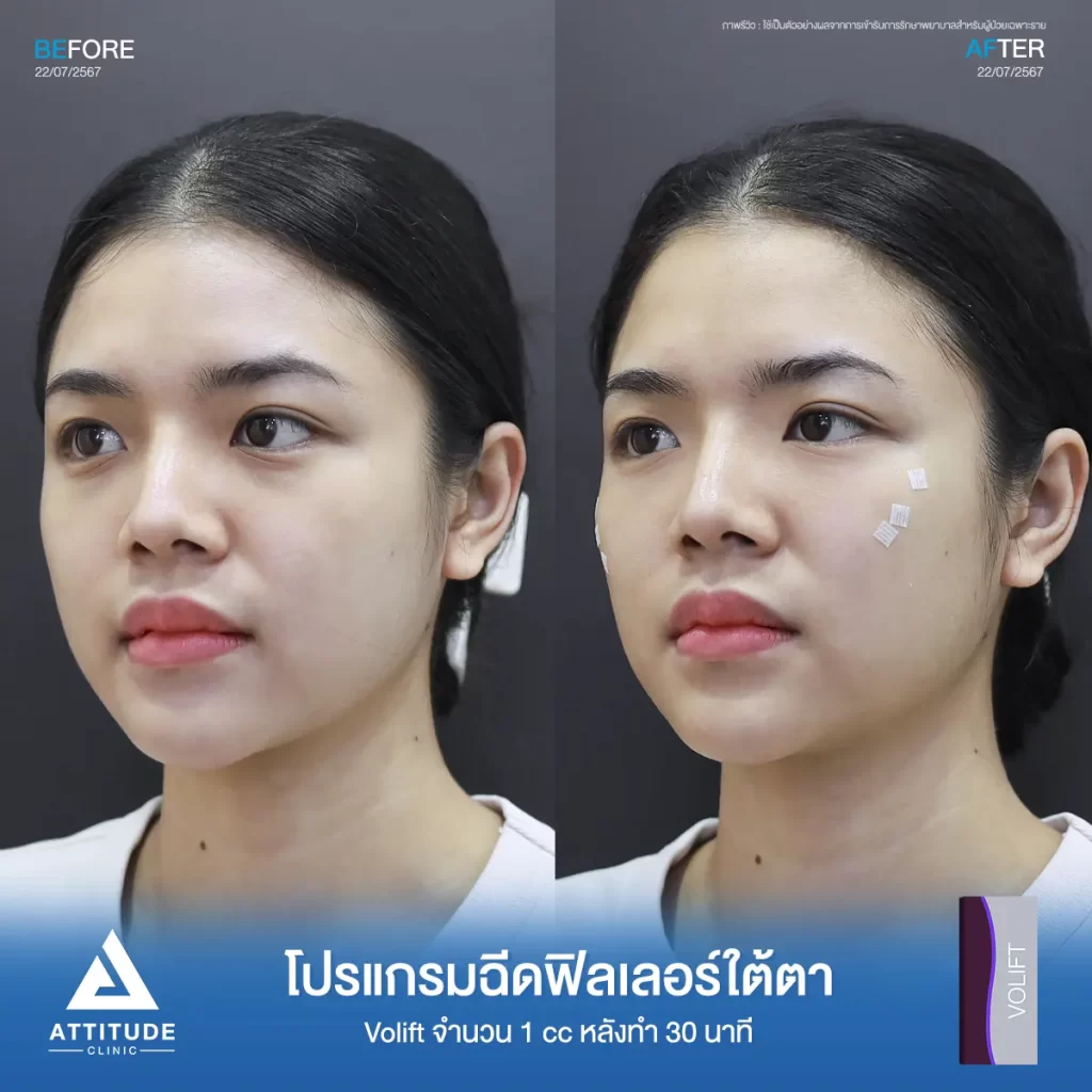 รีวิวโปรแกรมฉีดฟิลเลอร์ใต้ตาพี่พอฤทัย Juvederm รุ่น Volift จำนวน 1 cc ที่ Attitude Clinic