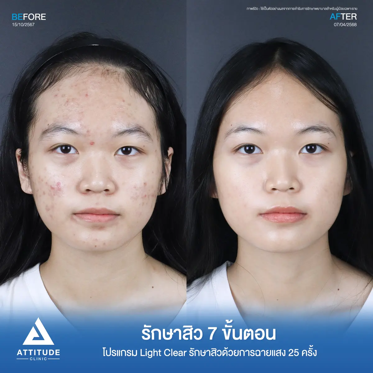 รีวิวรักษาสิวพี่แพม โปรแกรม Light Clear รักษาสิว 7 ขั้นตอน จำนวน 25 ครั้งที่ Attitude Clinic