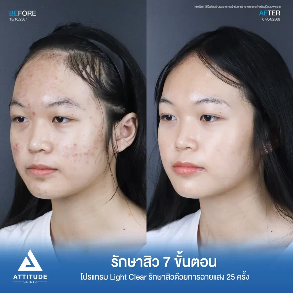 รีวิวรักษาสิวพี่แพม โปรแกรม Light Clear รักษาสิว 7 ขั้นตอน จำนวน 25 ครั้งที่ Attitude Clinic