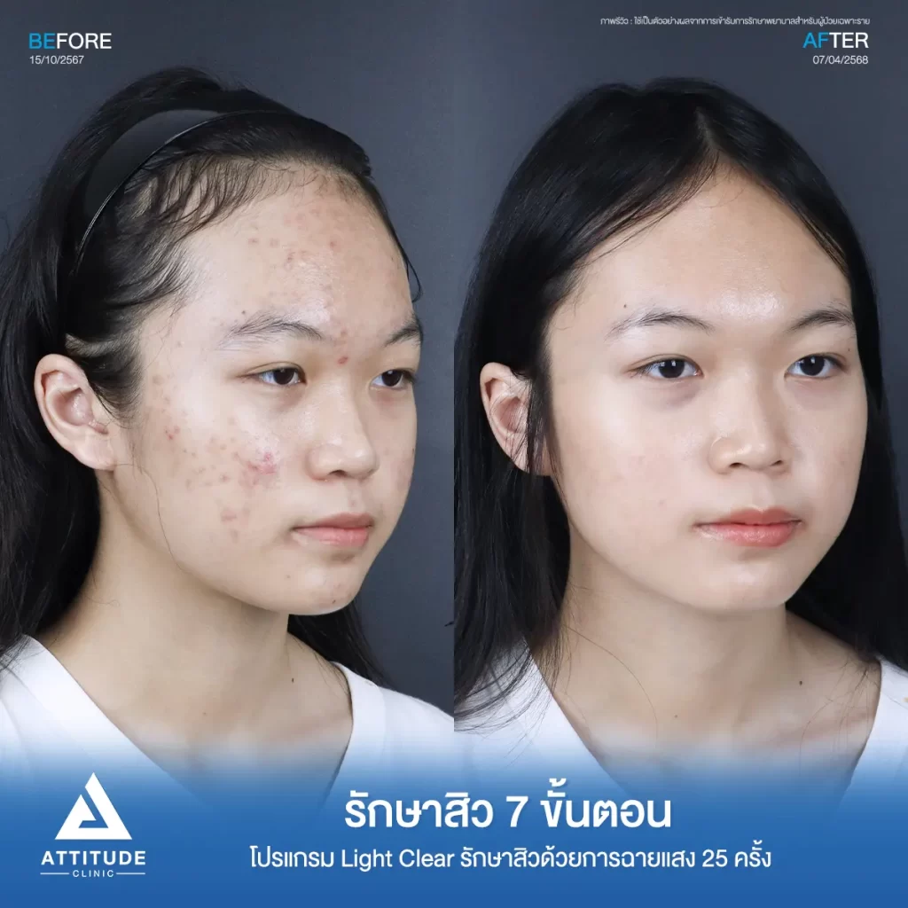 รีวิวรักษาสิวพี่แพม โปรแกรม Light Clear รักษาสิว 7 ขั้นตอน จำนวน 25 ครั้งที่ Attitude Clinic